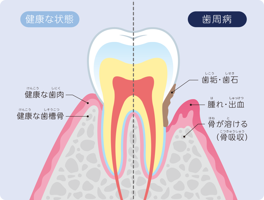 さまざまな病気のリスクに繋がる歯周病
